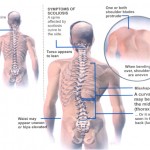 adults scoliosis