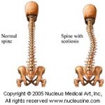 scoliosis pain